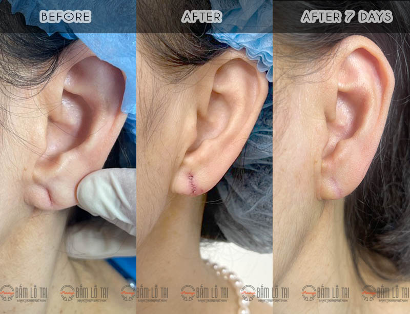 Vá lỗ tai chuẩn Y khoa